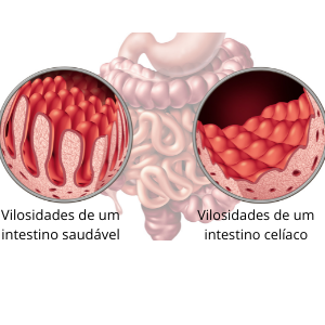 sintomas de doença celíaca em crianças