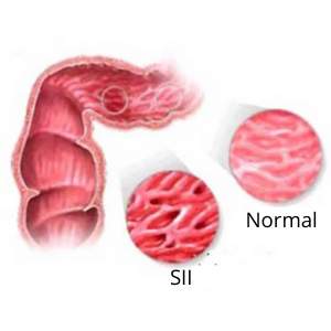 Síndrome do intestino irritável